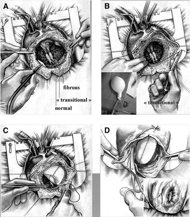Technique of left ventricular reconstruction for large akinetic segments. (A) Cryoablation at the limit of endocardial resection.