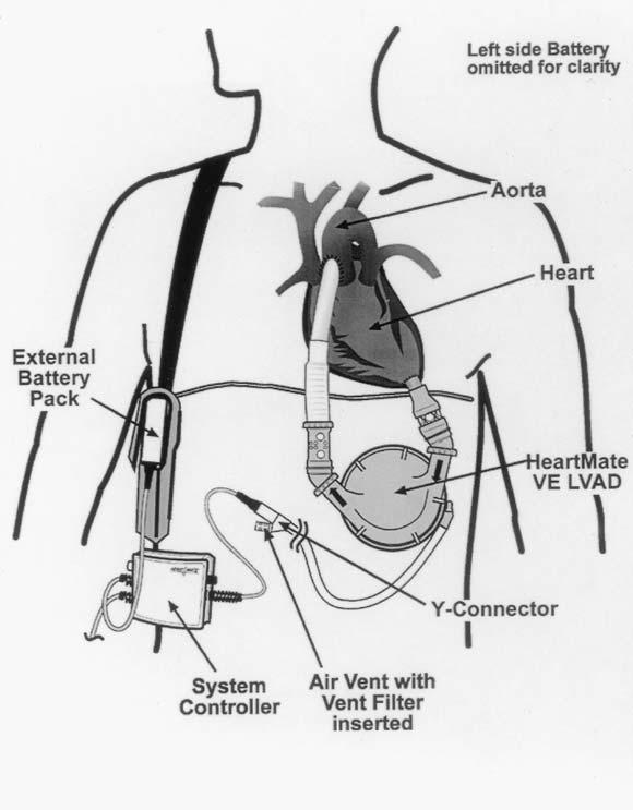 1. Balonul de contrapulsatie aortica folosit inca din 1960, reprezinta in prezent cel mai comun sistem de asistenta ventriculara.
