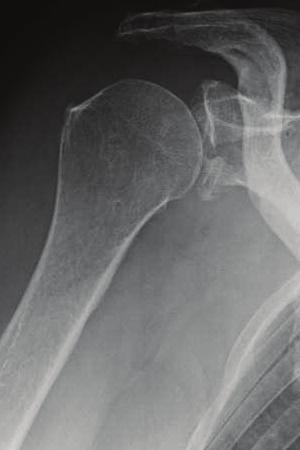 2 Case Reports in Orthopedics Figure 1: X-ray imaging at the time of injury. X-ray imaging after reduction of anterior shoulder dislocation.