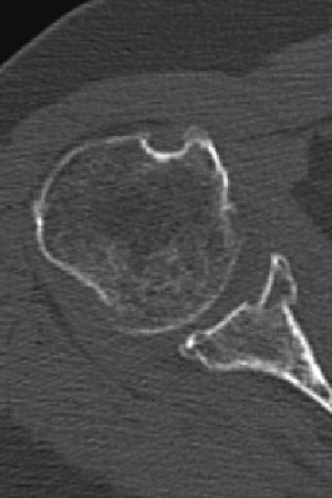 The width of the bony fragment was 30% of the glenoid length on the three-dimensional CT. of the supraspinatus muscle (Figure 3).