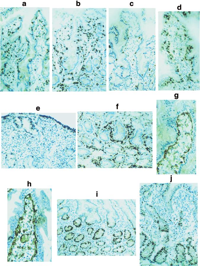 379 Figure 2 Peroxidase immunohistochemistry of snap-frozen mucosal biopsies. Positively stained cells are brown, while negatively stained cells show blue counterstaining.