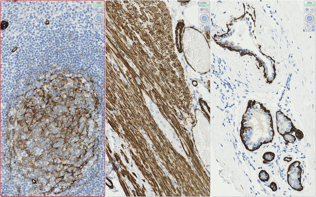 IHC Protocols and controls for Breast tumours SMH reaction pattern ICAPCs A weak to moderate, distinct cytoplasmic staining reaction in the follicular dendritic network of germinal centres.