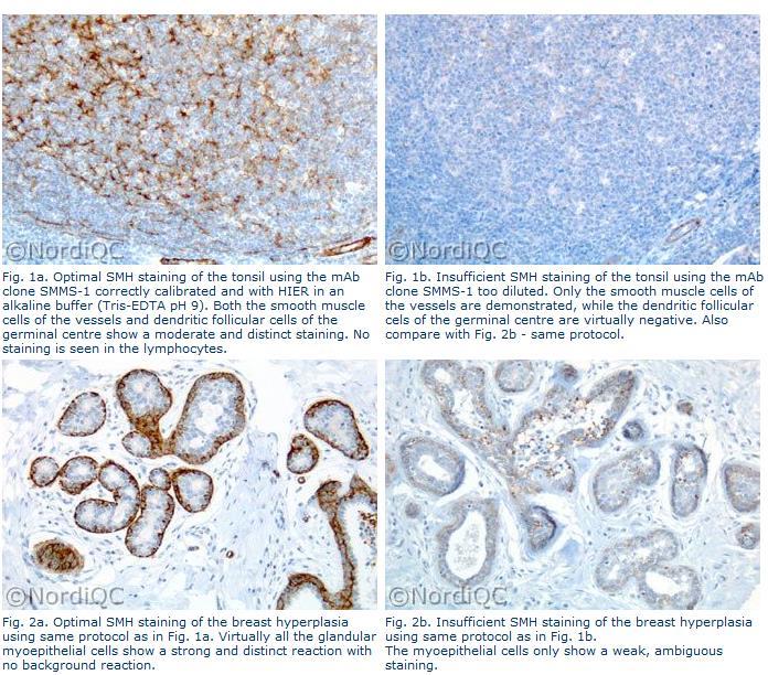 IHC Protocols and controls for Breast tumours mab clone SMMS-1 HIER in alk.