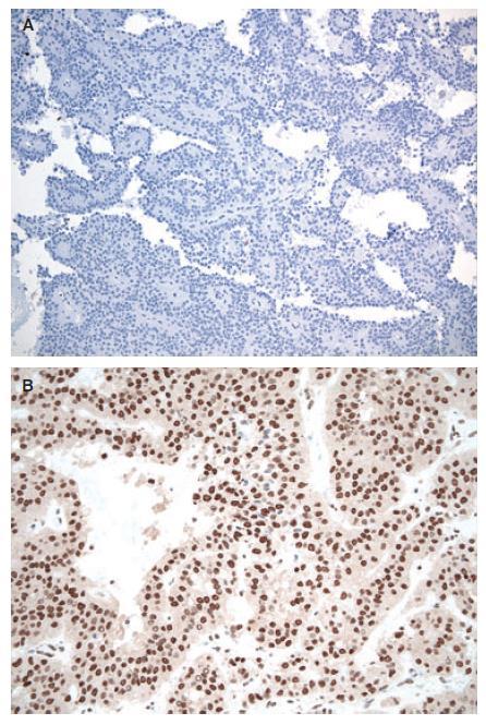 IHC Protocols and controls for Breast tumours mab 36B5 mab 36 Clone 36 reacts with cytoplasmic component