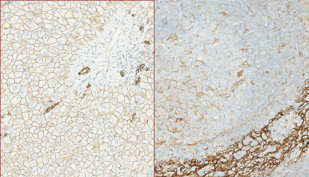 IHC Protocols and controls for Breast tumours ICAPCs Liver An at least weak to moderate membranous staining reaction of virtually all the hepatocytes.