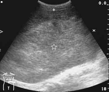 Figure 1 Figure 2 Figure 1. Ultrasonography of left-sided abdomen revealed a huge mass lesion (asterisk) with heterogeneous, relatively high echogenicity in left-sided abdomen.