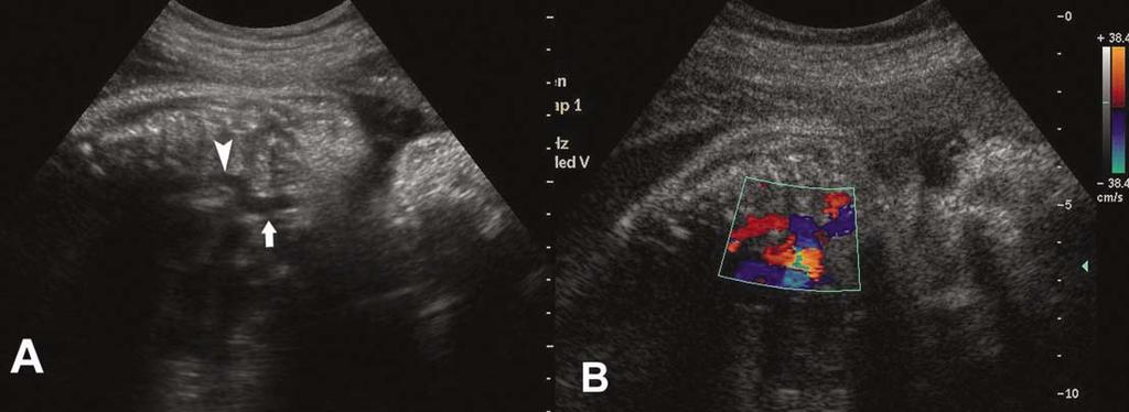 Interrupted and Left-Sided Subrenal Inferior Venae Cavae Figure 5. Oblique gray scale (A) and color Doppler (B) images of the fetal chest showing the azygos vein (arrowhead) joining the SVC (arrow).