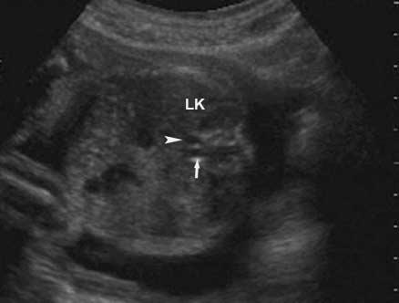 IVC (arrowhead) to the left of the aorta (arrow). LK indicates left kidney. weeks gestation. The same structures were confirmed postnatally by abdominal gray scale and color Doppler sonography.