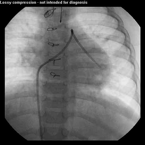 Pulmonary Vein Stenosis 7 Diagnostic Evaluation: Right Heart Cardiac Catheterization Gold Standard Establish diagnosis Ascertain