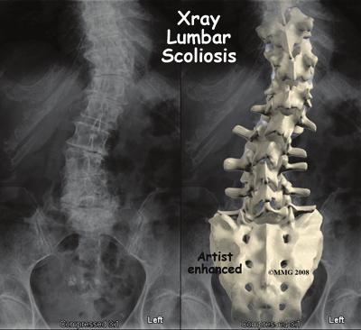 Degenerative scoliosis is more common the older we get. As our population ages, adult scoliosis will be even more common. It will be an increasing source of deformity, pain, and disability.