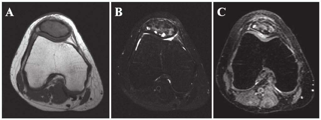 MOLECULAR AND CLINICAL ONCOLOGY 3: 207-211, 2015 209 Figure 3. Axial magnetic resonance images of an intraosseous lesion in the right patella.