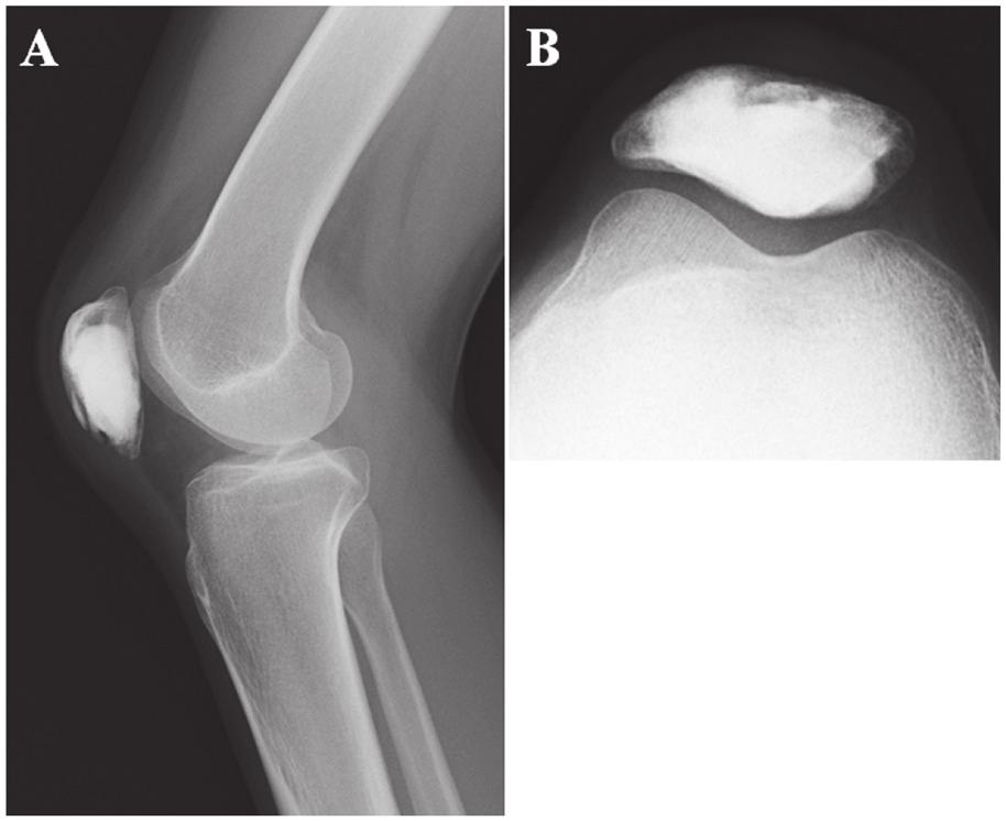 Follow up (A) lateral and (B) axial radiographs of the right knee 16 months after surgery.