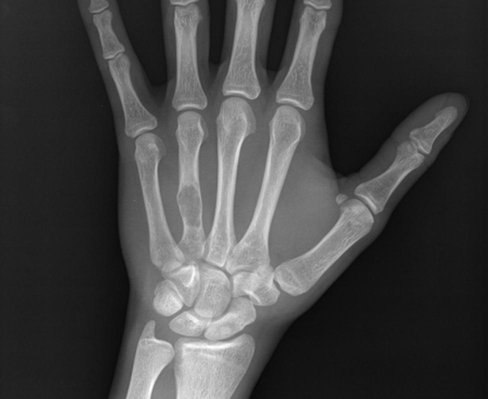 They are also more common in adults. On radiographs, they appear as homogenous, round, or oval-shaped lesions and radiopaque in cancellous bone.