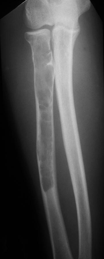 It is a metaphyseal lesion but can appear to be A Figure 4 A, AP radiograph of bilateral knees of a patient with multiple hereditary exostosis (osteochondromas).