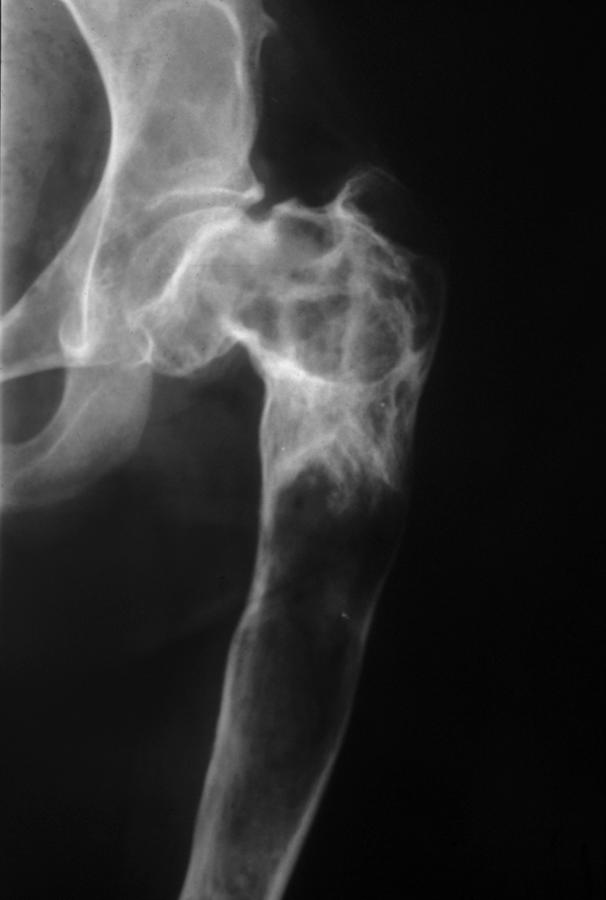 Incidental Tumor-like Conditions of Bone Unicameral bone cysts (UBC) are filled with serous fluid. These bone lesions are asymptomatic but can be seen in association with a pathologic fracture.