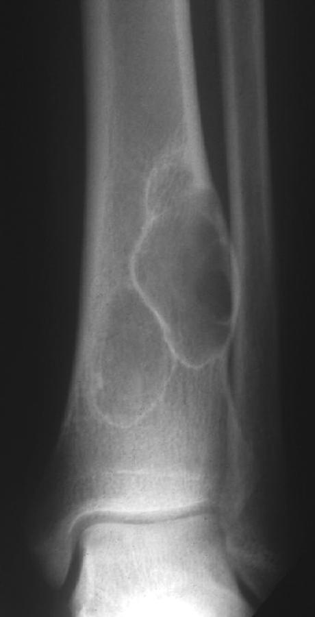 Bulletin of the NYU Hospital for Joint Diseases 2012;70(4):235-40 239 Figure 6 AP radiograph of the distal tibia and fibula demonstrating a well circumscribed eccentric lesion of the distal tibia