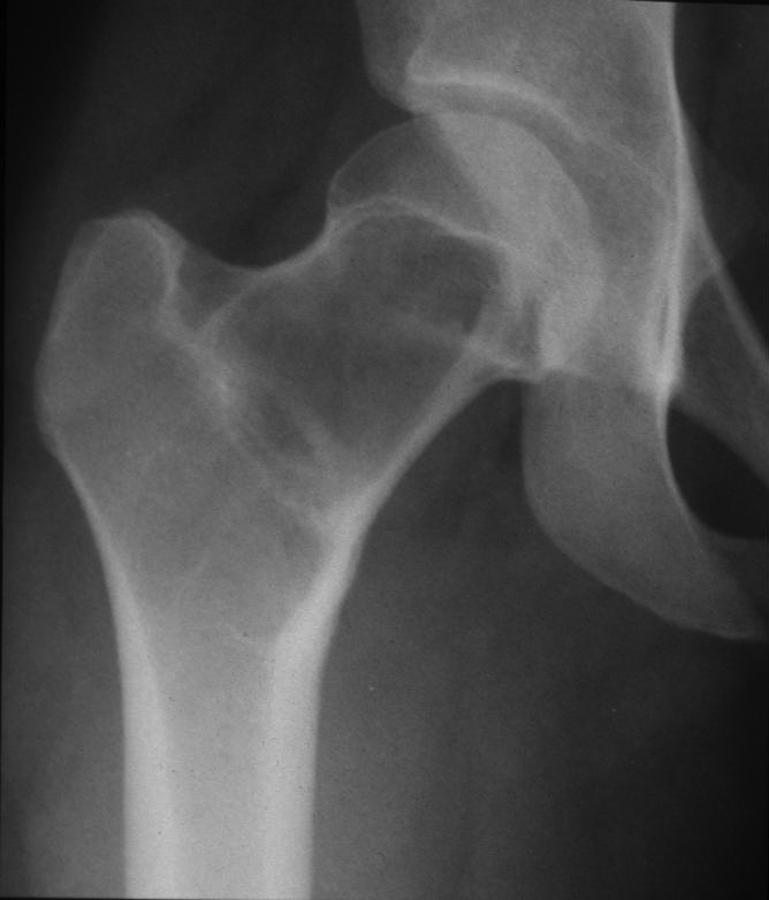 This appearance is consistent with a unicameral bone cyst. 7). It can appear to be in the diaphysis with growth.