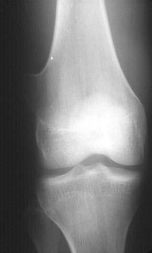 Osteochondroma: Osteochondromas are formed by radial growth of bone during childhood such that the lesion grows out away from the bone at an angle from the adjacent growth plate.