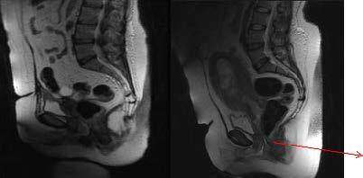 172 Figure 2: MRI images, sagittal sections; Image (A) there are torn both IUS, which causes funneling of the bladder neck