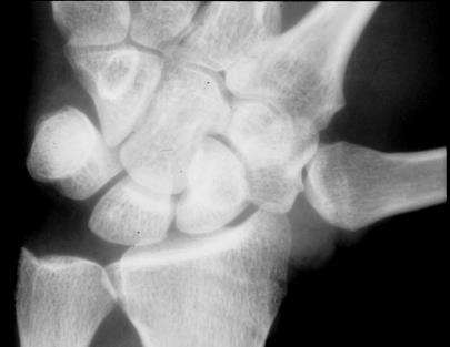 - Radial deviation Joint spaces maintained Scaphoid
