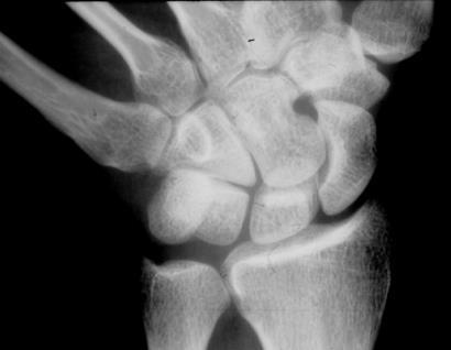 spaces maintained Scaphoid elongates on AP - Lateral