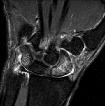 -Occult scaphoid Fracture NBA