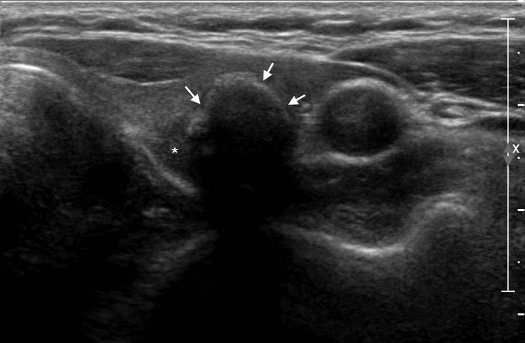thyroid contained more than 1 nodule. Pathologic results were reviewed by another radiologist (B.M.K.