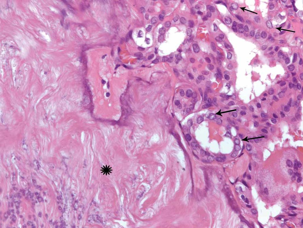 Thyroid Nodules With Eggshell Calcifications ed according to the size and location of the nodule and the presence of calcifications on the pathologic report.