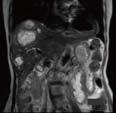 4: Liver metastases in patient with history of