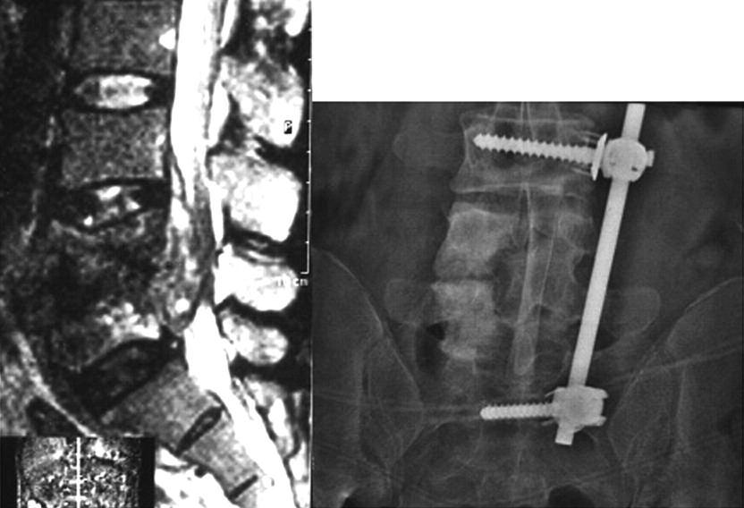 L5 CORPECTOMY FOR NON-TRAUMATIC LESIONS 97 Fig. 1. Case 3. A : Midsagittal MRI-scan showing anterior epidural abscess and destruction of the vertebral bodies L4 and L5.