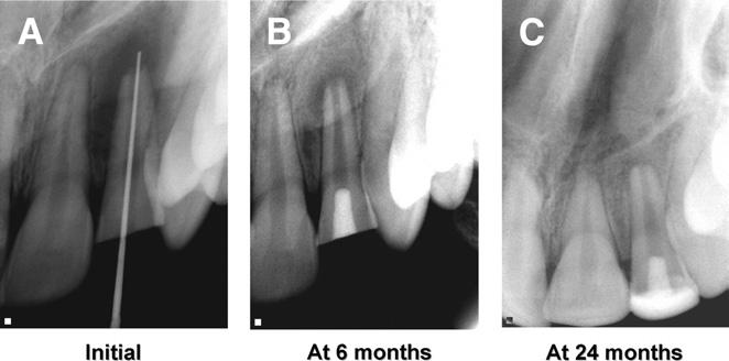 Material and Methods Fourteen cases of immature, nonvital maxillary anterior teeth presenting with or without signs and/or symptoms of periapical pathology were included in the study.
