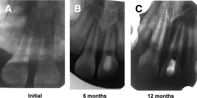 Figure 4. (A) Intraoral radiograph of upper central incisors showing wide root canals and open apices after trauma in a 14-year-old boy. On vitality testing, tooth #11 was vital, and #21 was nonvital.