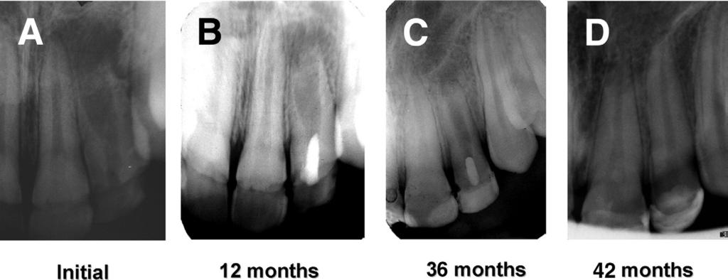 (C) At 1 year, further maturation and root lengthening can be appeciated. Discussion Apexogenesis is a natural physiologic process of root development.