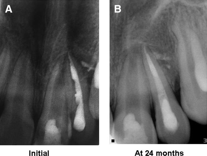 Figure 7. (A) An 8-year-old boy reported with pain and intraoral sinus in relation to teeth #21 and #22. Intraoral periapical x-ray showed wide-open apex of #21 but normal periradicular tissues.