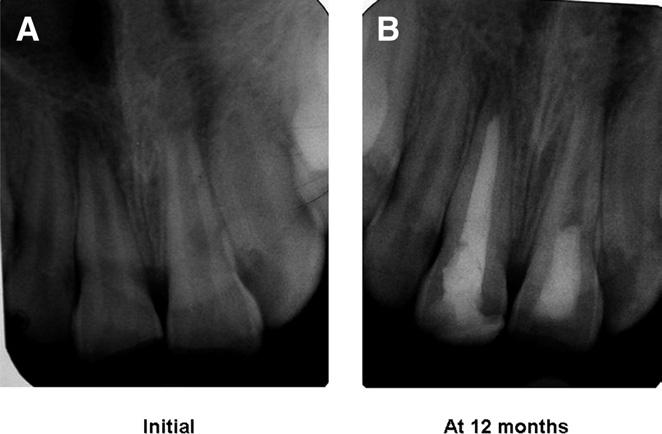 When he reported for treatment, endodontic treatment in #22 was completed by laterally condensed gutta-percha obturation.