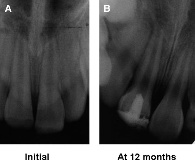 Revascularization was induced in #21, and conventional endodontics with calcium hydroxide was performed in #21. (B) Follow-up x-ray at 12 months showed a small residual periapical lesion.