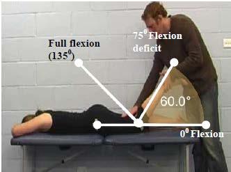 Primary Criterion #2 - Hip Extension deficit of 40. The figure shows normal anatomical range of 20 hip extension (6).