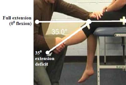 Primary Criterion #3 - Knee Flexion deficit of 75.
