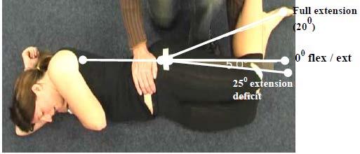 Secondary Criterion #2 Hip extension deficit of 25 but <40.