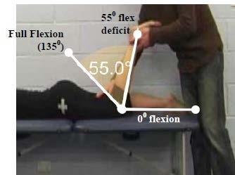 A 25 deficit is the maximum amount of hip extension that is permissible in order to meet this criterion.