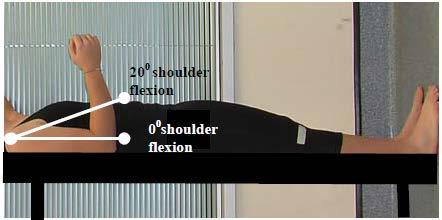 Criterion #1 Shoulder flexion loss of 3 muscle grade points (muscle grade of two).