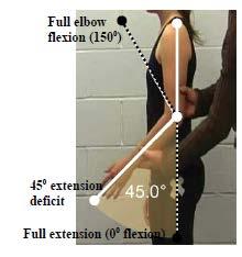 Criterion #4 Elbow extension deficit of 45 or ankylosis in any position*. The dashed lines in the figure are full elbow flexion (150 ) and full extension (0 ).