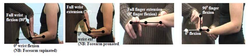 Criterion #6 Elbow extension loss of 3 muscle grade points (i.e., muscle grade of two)*. The figure shows manual resistance being applied at full elbow extension.