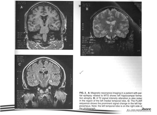Surgical Treatment Epilepsy surgery aimed at removing the seizurogenic zone. 2 important criteria are- Seizure should be localizable to a small brain region.