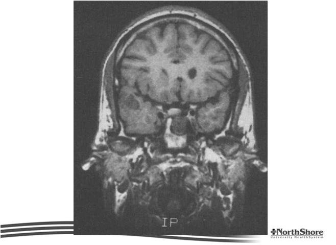 Neocortical epilepsy To determine that the patients do not have the more common
