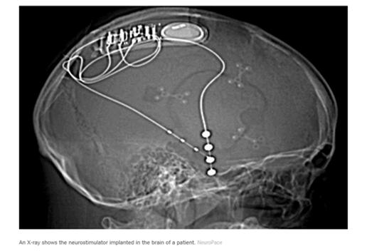 Responsive Neuro-Stimulation(RNS) 191 patients with medically refractory epilepsy. Implanted with responsive neurostimulator connected to depth or subdural electrodes placed at 1-2 seizure foci.