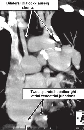 Right ventricle, anteriorly located, is dilated and hypertrophied.