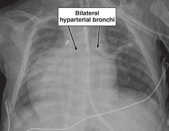 , Posteroanterior chest radiograph shows bilateral eparterial (right-sided) bronchi typical of asplenia.