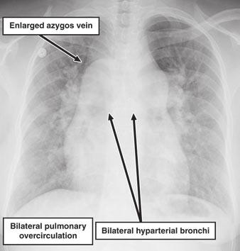 Visceroatrial Situs nomalies ilateral Trilobed Lungs ilateral ilobed Lungs Downloaded from www.ajronline.org by 46.3.194.217 on 11/22/17 from IP address 46.3.194.217. opyright RRS.