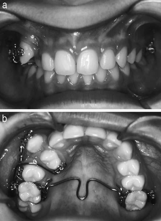 The utilization of two wires allowed palatal movement of the premolar with simultaneous mesial